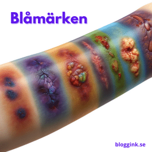 Blåmärken...bloggink.se 