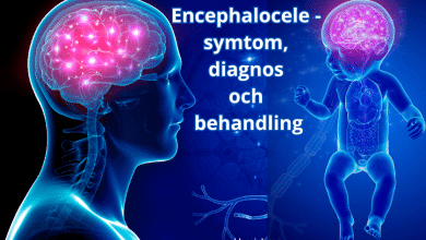 Encephalocele - symtom, diagnos och behandling....bloggink.se