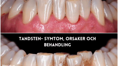 Tandsten- Symtom, orsaker och behandling...bloggink.se