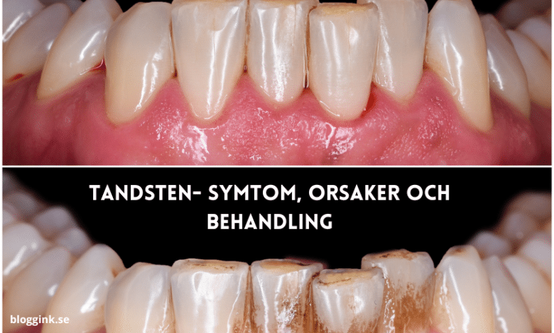 Tandsten- Symtom, orsaker och behandling...bloggink.se