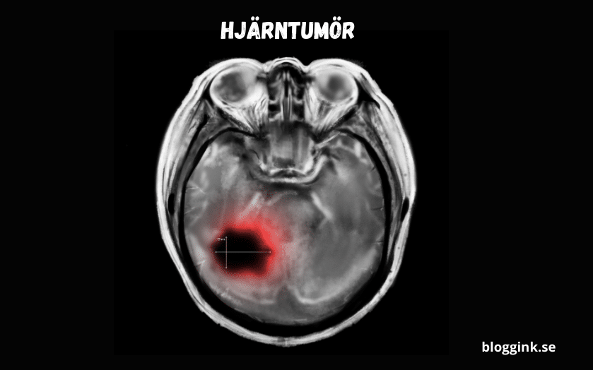 Hjärntumör...blöoggink.se