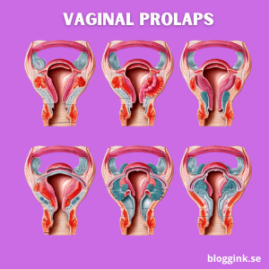 Vaginal prolaps...bloggink.se