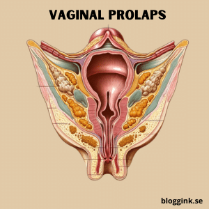 Vaginal prolaps...bloggink.se