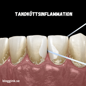 tandköttsinflammation...bloggink.se